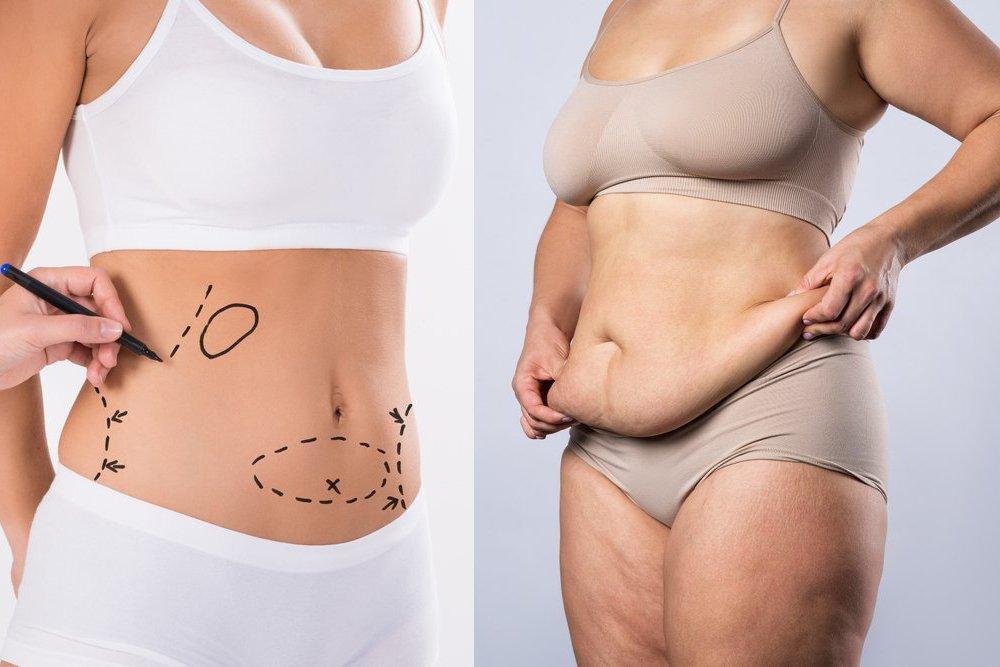 Liposuction-vs-Tummy-Tuck-v1