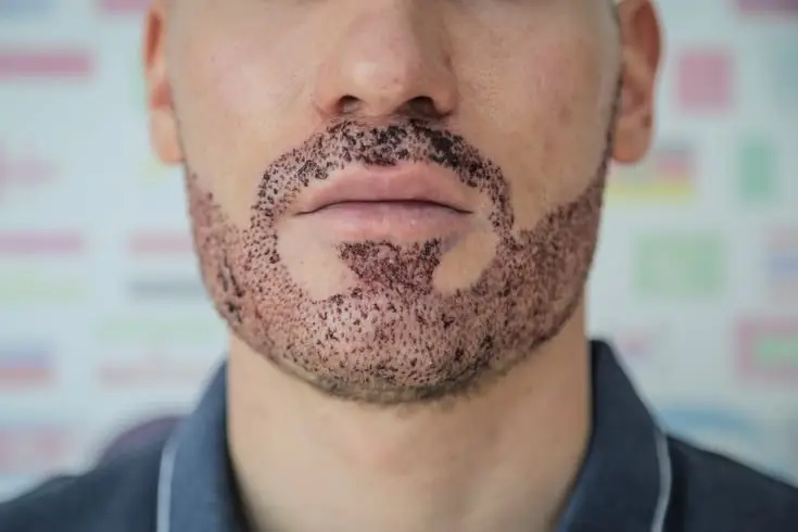 Mustache-Transplant