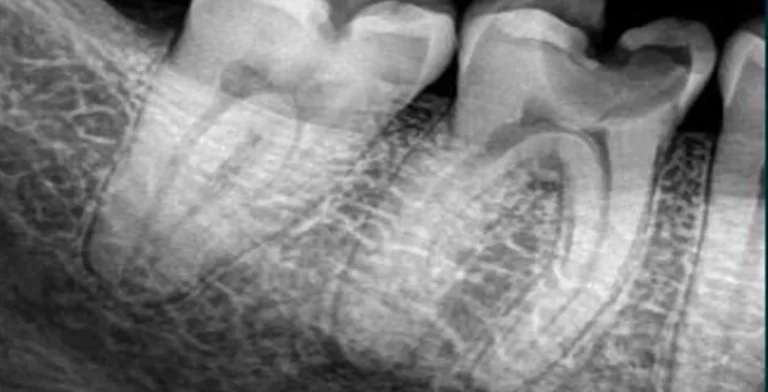 endo-ba01-before-treatment-vitrin-clinic