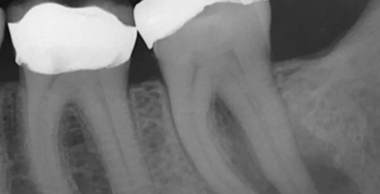 endo-ba02-before-treatment-vitrin-clinic