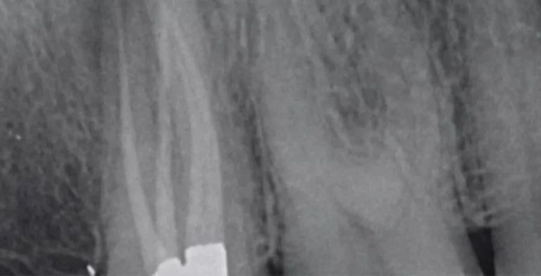 endo-ba03-after-treatment-vitrin-clinic