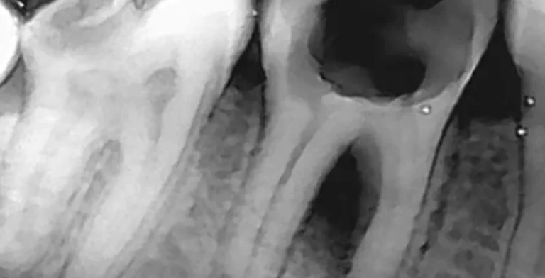 endo-ba04-before-treatment-vitrin-clinic