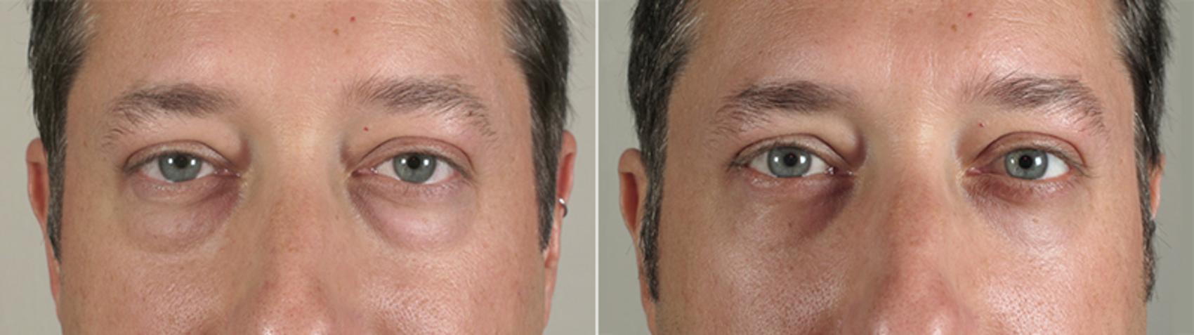 eyelid-surgery-48-view-1-detail