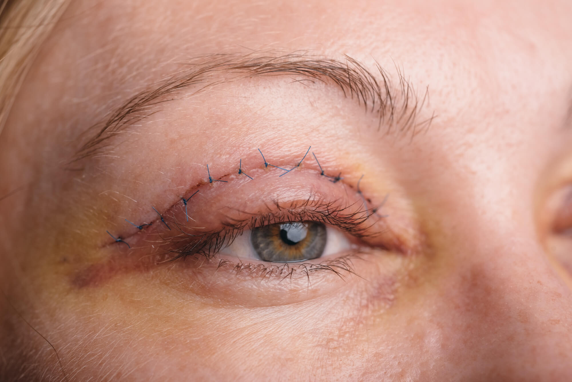 eyelid-surgery-recovery