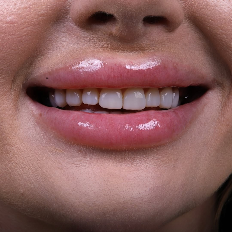 hollywood smile (19)