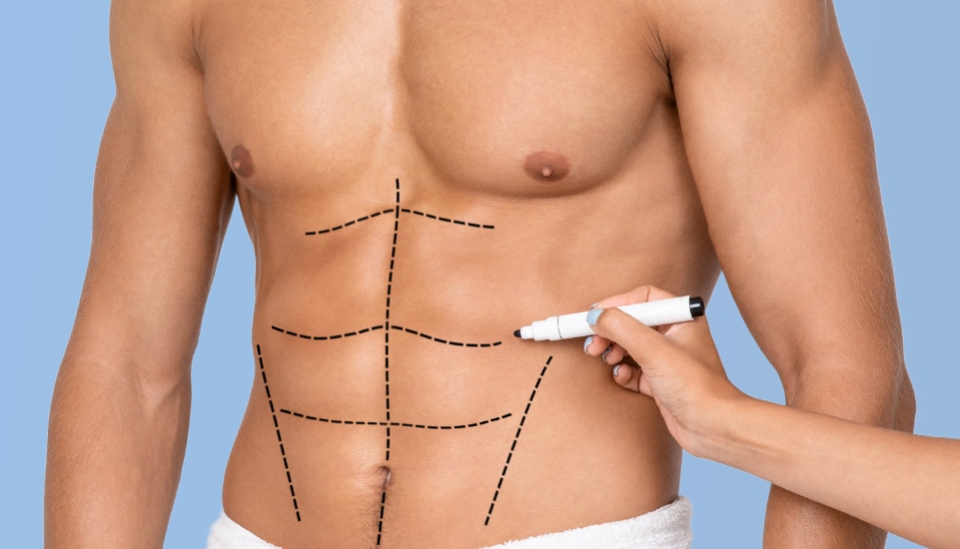 image-abdominal-etching