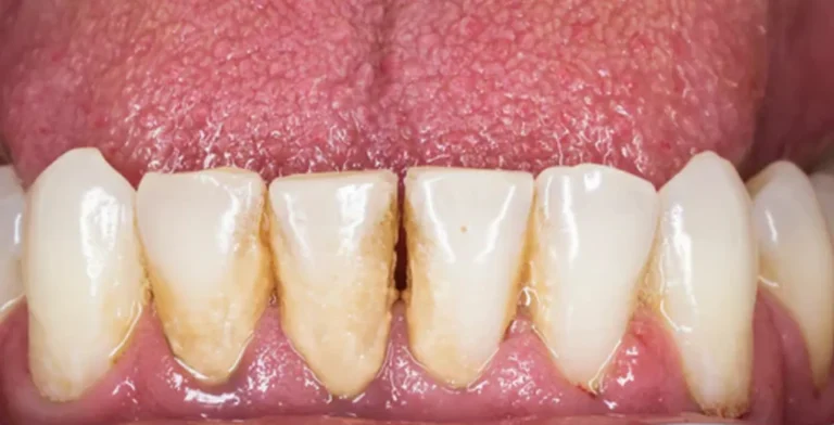 periodontics-ba02-before-treatment-vitrin-clinic