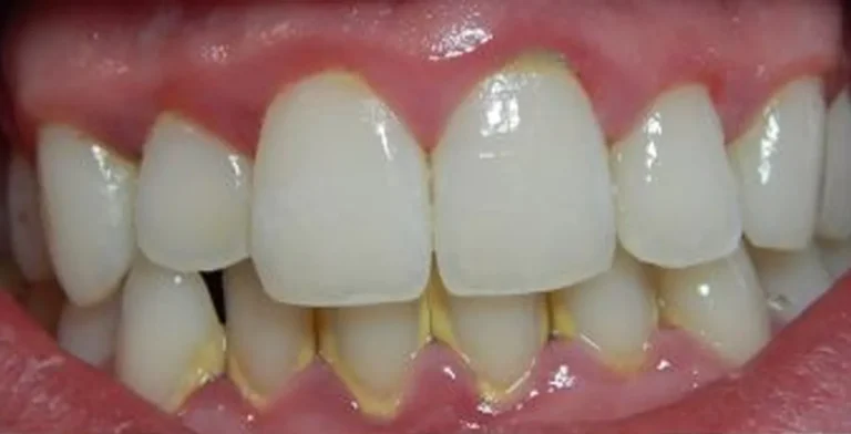 periodontics-ba03-before-treatment-vitrin-clinic