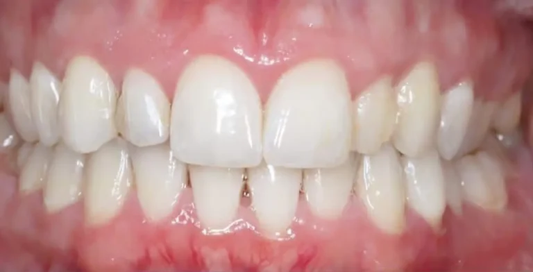 periodontics-ba04-after-treatment-vitrin-clinic