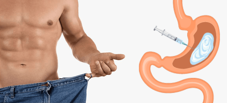 stomach-gastric-botox