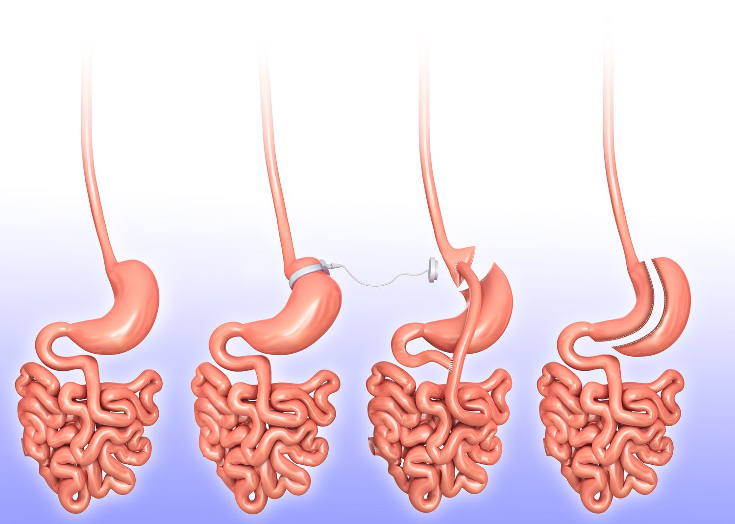 weight-loss-surgery-illustration-590279171-5aeb46d5a18d9e0037f79089